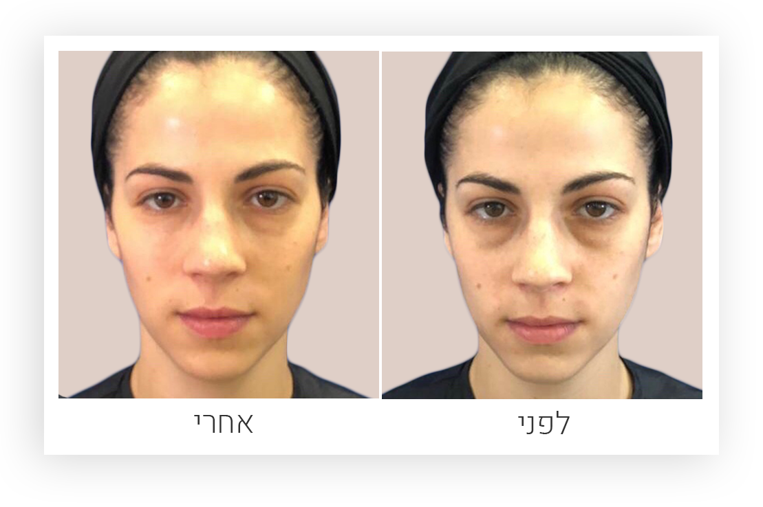 טיפול פנים – לפני ואחרי