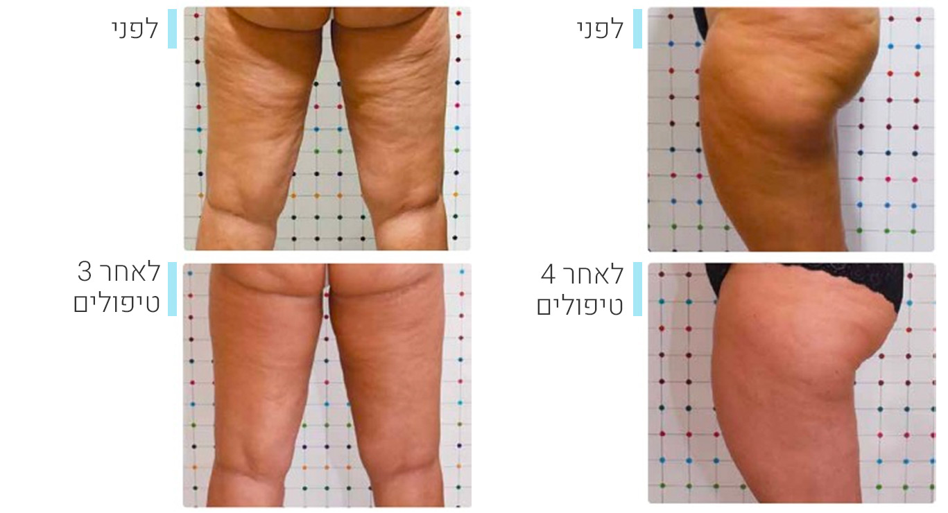 onda-before-after2