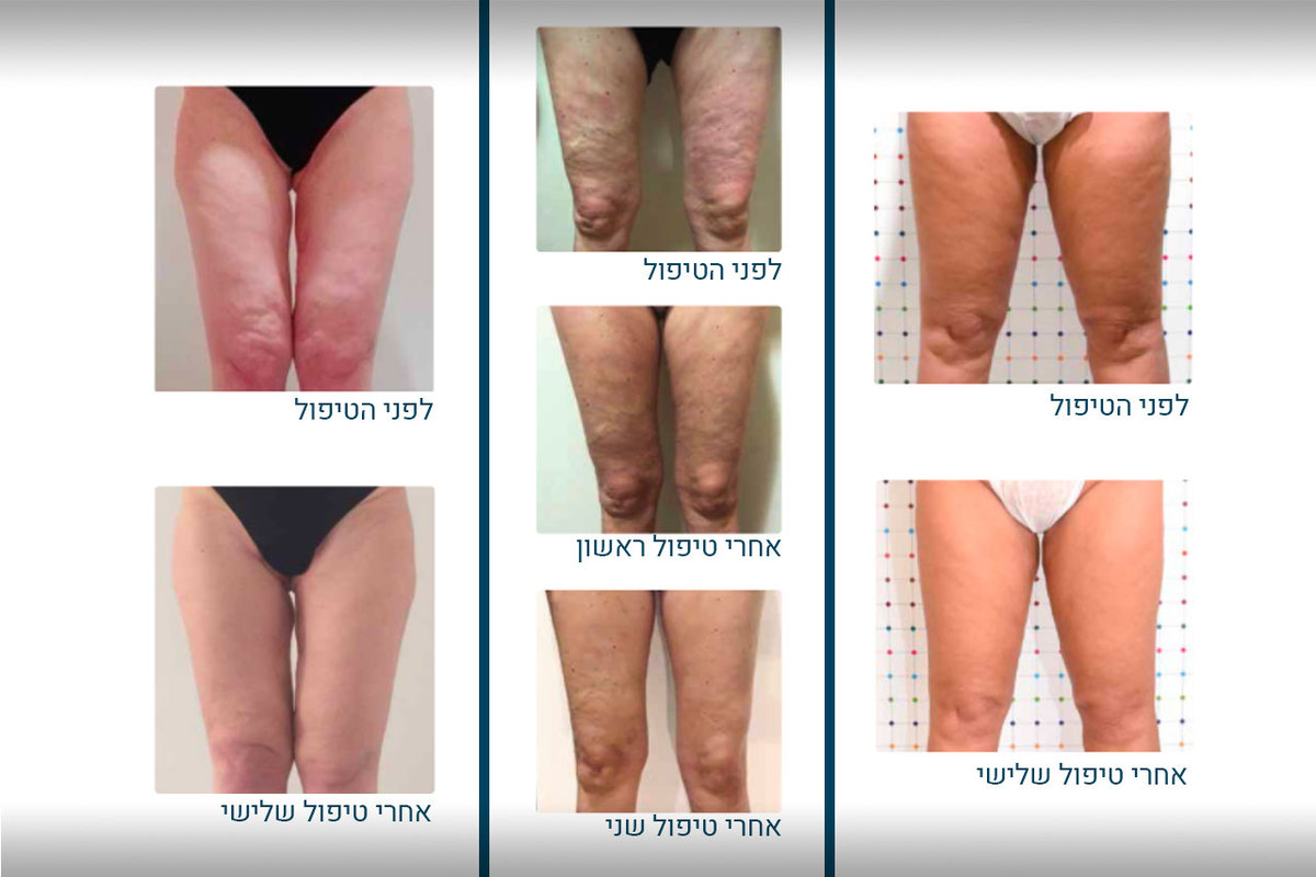 השוות טיפול עור רגליים לפני ואחרי